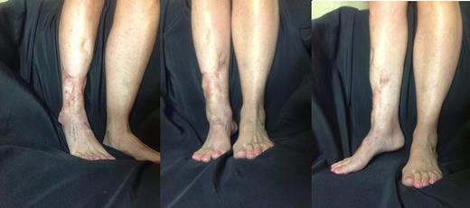Post-fat transfer lower extremity three-view comparison.