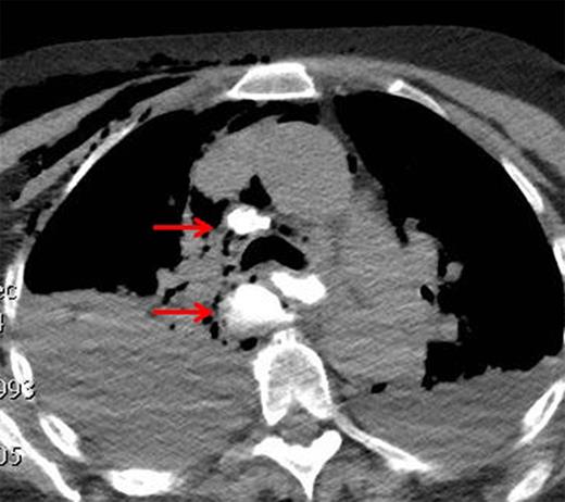 CT demonstrating extravasation of oral contrast into the right chest and mediastinum.