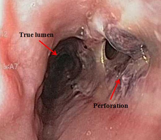 Esophagogastroduodenoscopy confirming site of perforation along the right lateral wall of the mid-esophagus.