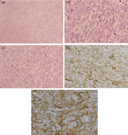 (a–c) Photomicrograph of histologic material shows spindle cells (haematoxylin and eosin staining, ×100 × 200 × 400, respectively). (d and e) CD34 immunohistochemical stain of the resected mass from the groin with tumour cells that have strong positivity.