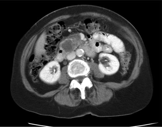 CT shows cystic mass in the uncinate process of pancreas measuring 4 cm in 2008.