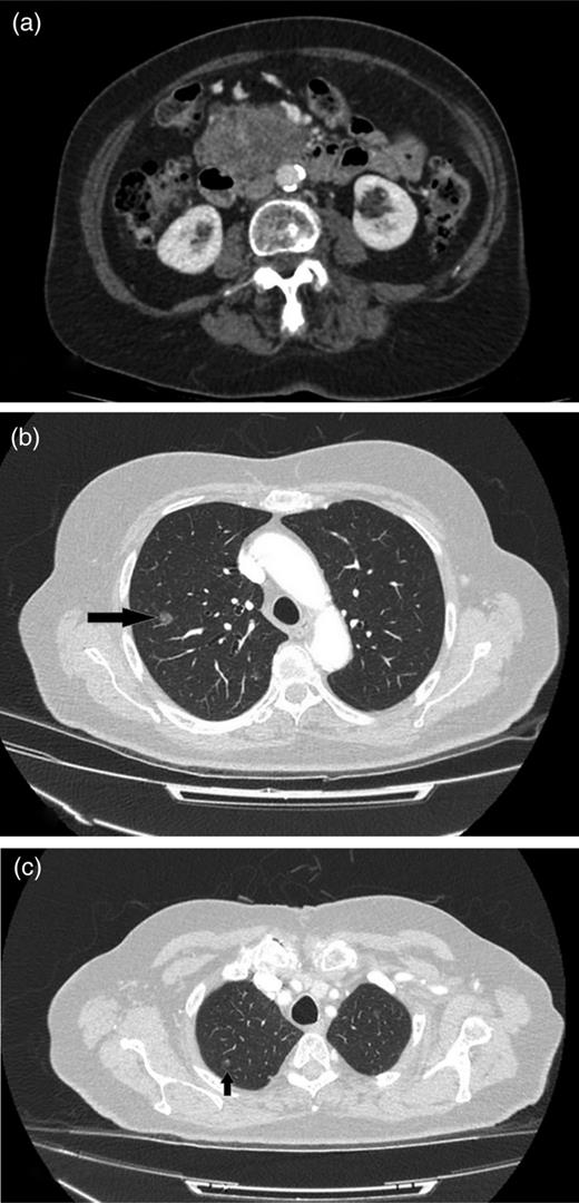 (a) CT image of 2015, a mass lesion in the head of the pancreas with solid and cystic components (bunch of grapes appearance). The lesion measures 7.2 × 4.8 cm in the axial dimension and 7.2 cm in the coronal dimension. (b and c) Multiple focal ground-glass density nodules in both upper lobes of the lungs, largest measuring 1 cm in the right upper lobe.