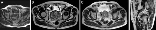 MRIs of the patients’ groins during the follow-up. Arrow indicates the absorbable mesh/new connective tissue. Arrowhead indicates the permanent mesh. Asterisk indicates the permanent mesh. (A) Axial T2-weighted image, 1 month postoperative. (B) Axial T2-weighted image, 2 years postoperative. (C) Axial T2-weighted image, 3 years postoperative. (D) Sagittal T2-weighted image, 3 years postoperative.