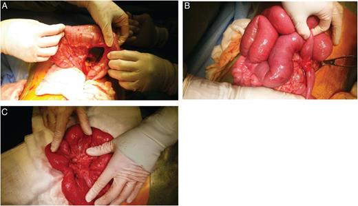 Intra-operative pictures (A) internal hernia of jejunal loop resulting in small bowel obstruction with proximal bowel dilatation. (B) Mesenteric defect in mesocolon. (C) Subsequent stricture in area of jejunal loop previous caught in mesenteric defect.