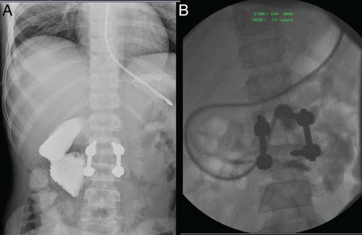(A) Barium swallow through NG demonstrating SMA syndrome with cut-off at D3. (B) Advancement of NG tube past D3 into jejunum prior to commencing feeds.