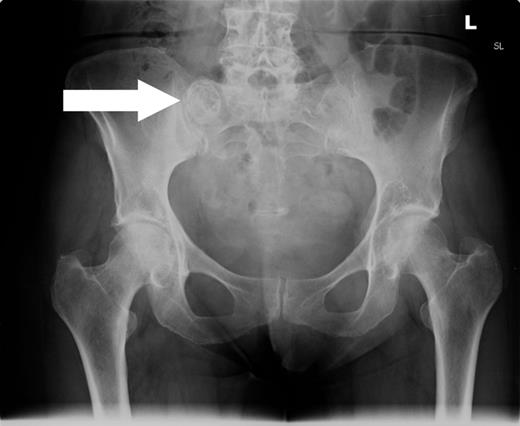 Anterior–posterior radiograph of the pelvis demonstrating a calcified ovoid lesion projected over the right sacral ala.