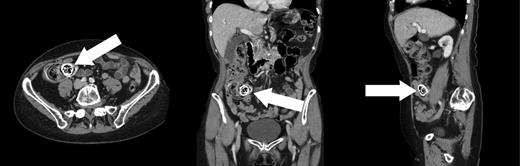Axial, coronal and sagittal CT views showing a giant appendicolith within the base of the appendix. Calcification and the laminar structure are well demonstrated on CT.