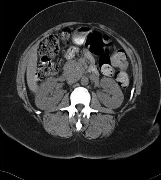 CT of the abdomen and pelvis showing mass in head of the pancreas.
