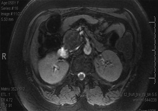 MRI of the abdomen and pelvis showing mass in head of the pancreas.