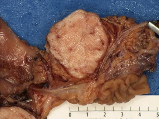 Gross pathology showing a 3.5 ×3 ×3-cm white, firm, well-circumscribed mass located in the head of the pancreas.