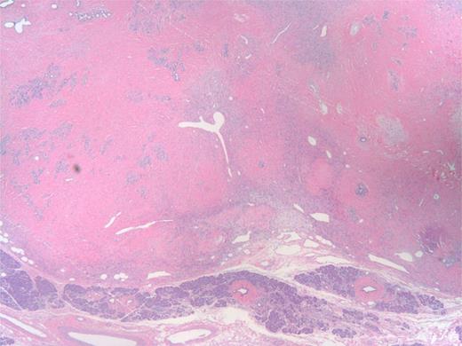 Low power of tumor (upper part) and uninvolved pancreas (bottom). The tumor has stag horn vessels, cellular areas of spindle cell proliferation and hyalinized ‘keloid areas’.