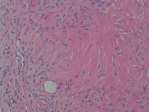 High power showing spindle cells of minimal nuclear pleomorphisms.