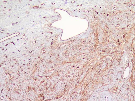 Immunostain for cd 34.