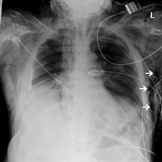 CXR performed after thoracostomy and chest tube placement displaying areas of subcutaneous emphysema (white arrows).