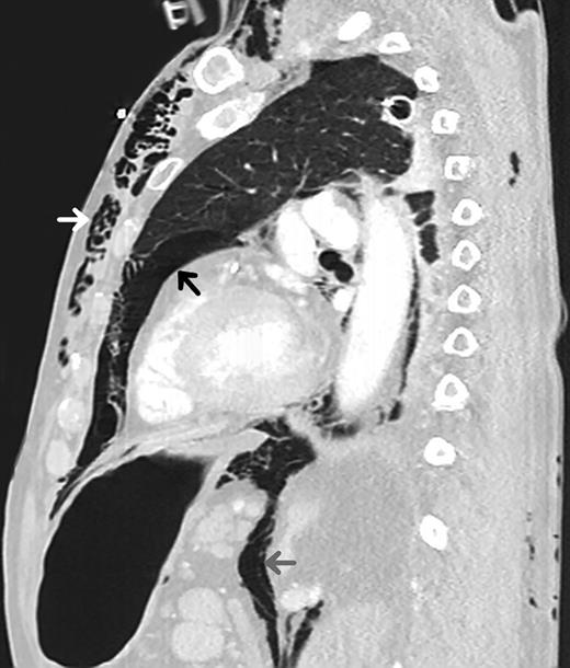 Chest CT scan obtained shortly after patient's arrival displaying evidence of subcutaneous emphysema (white arrow), pneumomediastinum (black arrow) and air tracking down resulting in pneumoperitoneum (gray arrow).