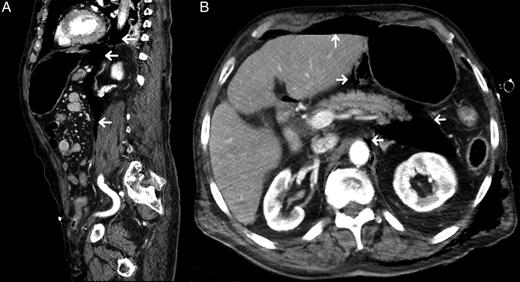 Sagittal view from CT abdomen/pelvis with contrast (A) showing areas of free air in mediastinum and thoracic cavity spreading downward into peritoneum (white arrows). Coronal view (B) showing free air within the abdominal cavity. Pockets are visible around the aorta, pancreas and liver (white arrows), as well as the presence of subcutaneous emphysema.