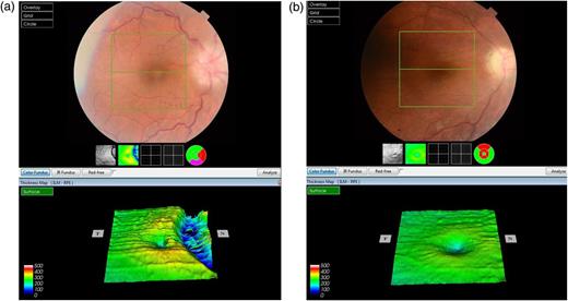 (a) Preoperative OCT and fundus photography of the right eye show the papilledema and macular pucker. (b) After first operation, control OCT and fundus photography in the second postoperative month show that both papilledema and macular edema subside remarkably.