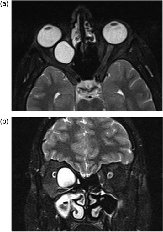 (a and b) Axial-coronal orbital magnetic resonance imaging show the homogenous unilocular lesion that is adjacent to optic nerve and medial rectus muscle in the intraconal space and displacing optic nerve laterally.