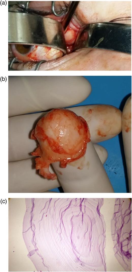 (a) The appearance of the peroperative solid mass that locates intraconal space. (b) The appearance of the cyst capsule that is thick, whitish and fragile. (c) Histopathologic appearance of the hydatid cyst staining Haematoxylin and Eosin (H&E).