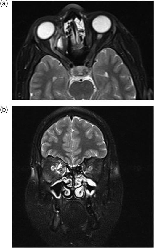 (a and b) After first operation, control MRI in the second postoperative month shows a small cyst displacing optic nerve laterally.
