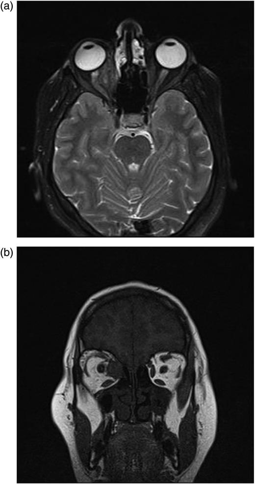 (a and b) After second operation, Control MRI in the first postoperative month shows granulation tissue.