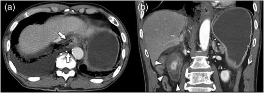 Chest and abdominal computed tomography findings. (a) Horizontal cross section. The right wall of the abdominal esophagus is perforated (arrows). (b) Coronal section. The duodenal wall is markedly thickened (arrowheads).