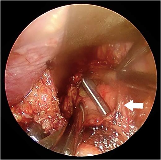 A picture of the perforated site. A nasogastric tube was found via the perforated site during transabdominal manipulation (arrow).