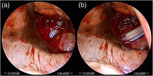 Thoracoscopic mediastinal drainage. (a) The angle of the drain was too steep at first. (b) The drain was successfully inserted in the deepest region of the chest by adjusting the angle of the drain.