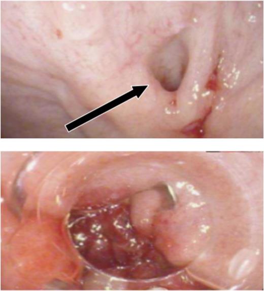 Endoscopic attempt to close the fistula. Oesophago-gastro-duodenoscopy sequence that shows the opening point of the fistula (arrow) and its stabilization with clips.