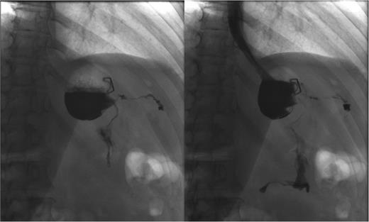 Persistent leak detected with GS. The images clearly show persistence of the leak along with the fistula tract. One of the endoscopic clips previously positioned is also visible.