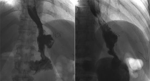 Postoperative GS. Two months after the laparoscopic fistulectomy, no persistent leak or fistula tract can be demonstrated.