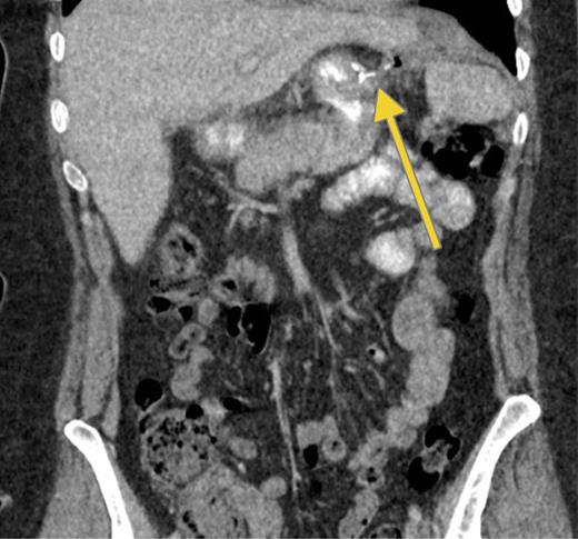 Recurrence. Computed tomography scan with oral contrast demonstrating a persistent small leak (arrow) 3 weeks after a negative GS.