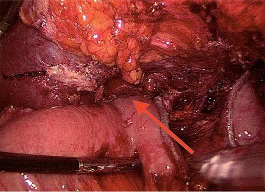 Roux-en-Y reconstruction. Laparoscopic total gastrectomy performed 5 years after the sleeve gastrectomy. Oesophago-jejunal anastomosis is indicated by the arrow.