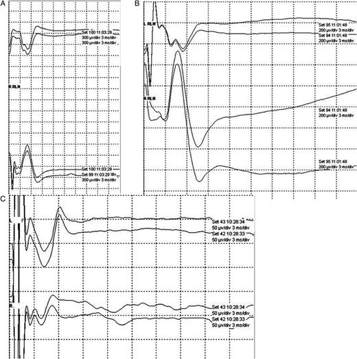 Stimulation of the HCN with the Dragonfly neuromonitoring system at 0.5 mA demonstrated a distinct waveform (A), with an onset latency of 3.2 ms and a peak-to-peak amplitude of 882.1 µV. This waveform was distinct from those produced by stimulation of the proximal RLN (B) or EBSLN (C). Note different scales used to best depict each of the responses.