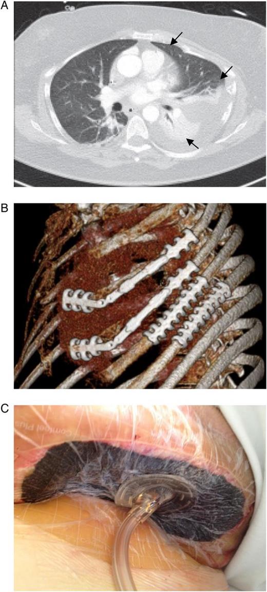 (A) Computed tomography scan of the chest with multiple displaced anterolateral rib fractures and hematothorax (arrow). (B) Osteosynthesis of four ribs with StraTos™ (MedXpert GmbH, Heitersheim, Germany). (C) Applied VAC® system therapy.