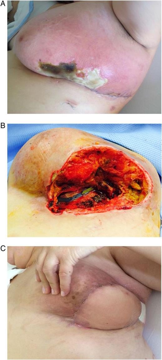 (A) Wound infection with partial necrosis and lymphatic leakage with lymphedema of the left breast. (B) Status after repeated surgical wound debridement and necrosectomy. (C) Result after breast reconstruction with pedicled myocutaneous Latissimus dorsi island flap.