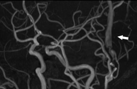 A magnetic resonance angiogram showed the dilated STV (arrow).