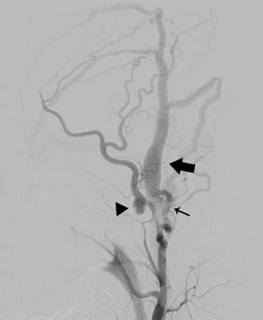 Left external carotid arteriography showed a high-flow AVF from the parietal branch of the STA (thin arrow) to the STV (wide arrow), and an aneurysm on the frontal branch of the STA (arrowhead).