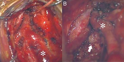 Intraoperative microscopic view. (A) The STV (asterisk) was extremely dilated and reddish. (B) The STA (arrow) was connected to the STV (asterisk).
