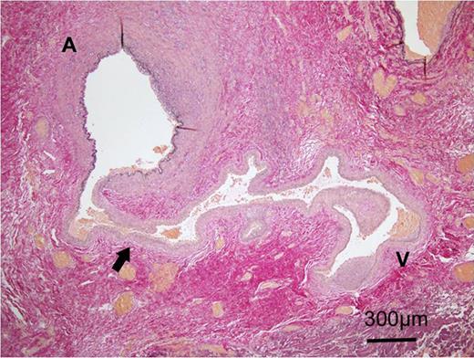 Histopathological photomicrograph with Elastica van Gieson stain showed that a thin-walled vessel lacking in internal elastic membrane (arrow) connected the artery (A) and the vein (V).