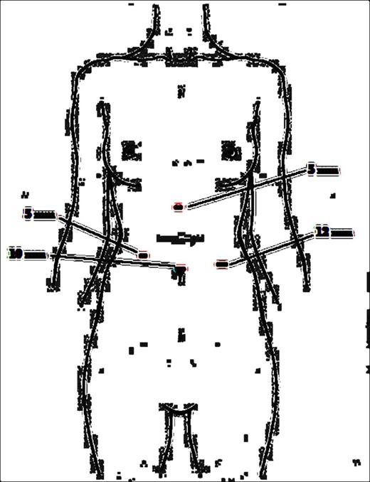 Trocar displacement.