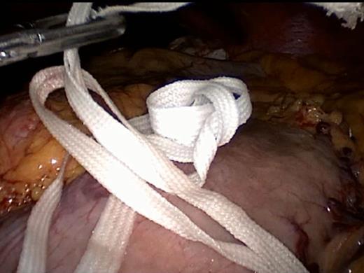 Passing the polyester tape around the stomach.