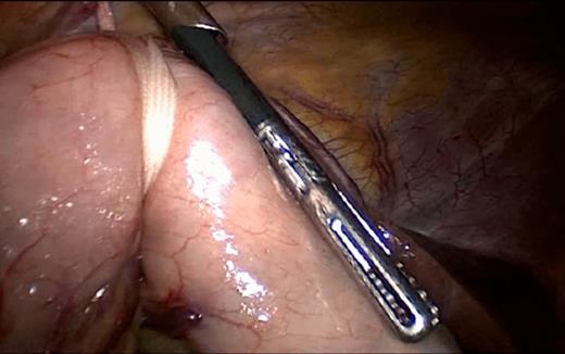 Subxiphoid trocar back in place with a working instrument.