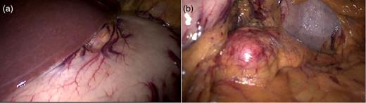 (a) Operative view on the beginning of the procedure and (b) operative view after gastric retraction with the polyester tape.