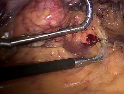 Assistant retracting the pancreas through the subxiphoid trocar.