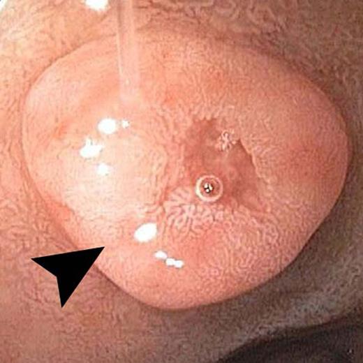 Endoscopic view of the duodenal neuroendocrine tumor.