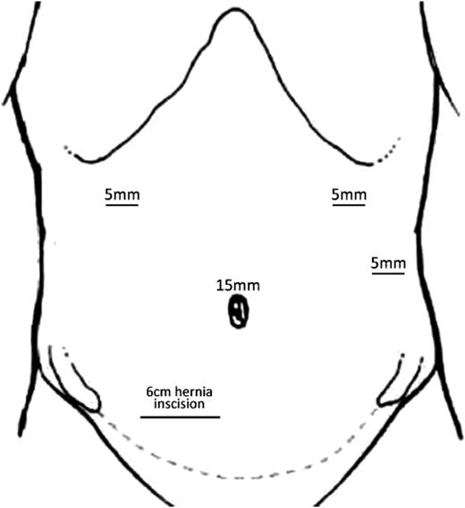 Schematic skeleton of various surgical incisions used.