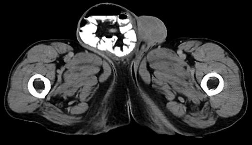 CT abdomen showing the large inguinal hernia.