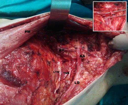 AA muscle extending from LD muscle to under surface of pectoralis major tendon in the left axilla crossing over axillary neurovascular structures (in view). AA, axillary arch; PM, pectoralis major; LD, latissimus dorsi muscle; AV, axillary vein; TNB, thoracodorsal neurovascular bundle; LTN, long thoracic nerve.