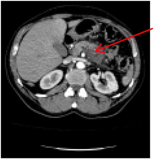 Preoperative computer tomography, mass (arrow) located in corpus of the pancreas.
